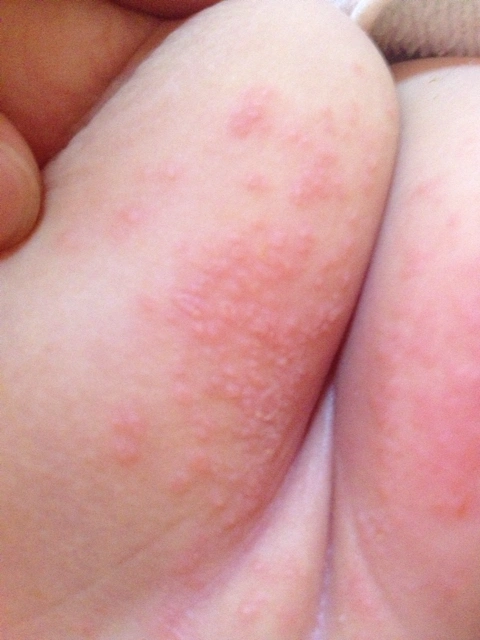 尿布大腿内侧突然起了红疙瘩 而且越来越多,会不会是第一次吃米粉过敏