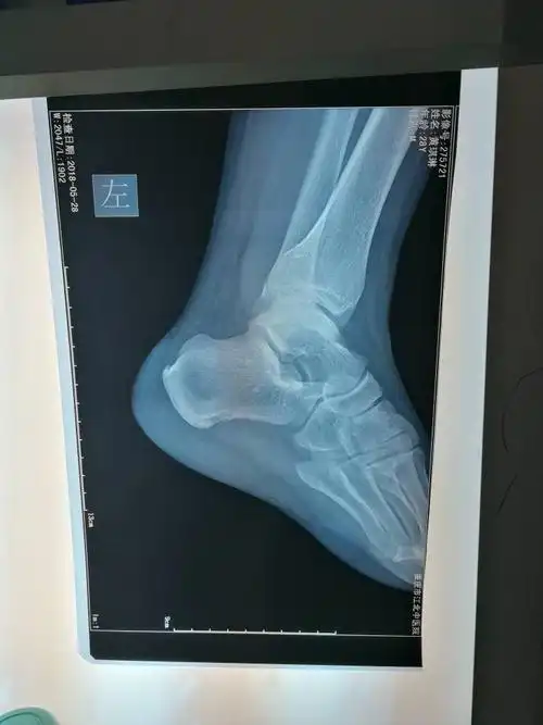 脚后跟红肿疼痛是骨刺吗