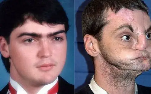 因枪走火而毁容后,诺里斯失去了鼻子,嘴唇以及大部分嘴的功能(网页