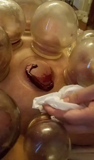 胆小慎入严屹宽保养自己后背拔罐血浆直流