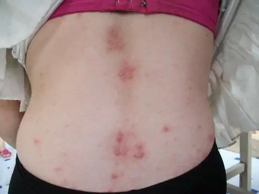 毒疮图片 (38)_有来医生