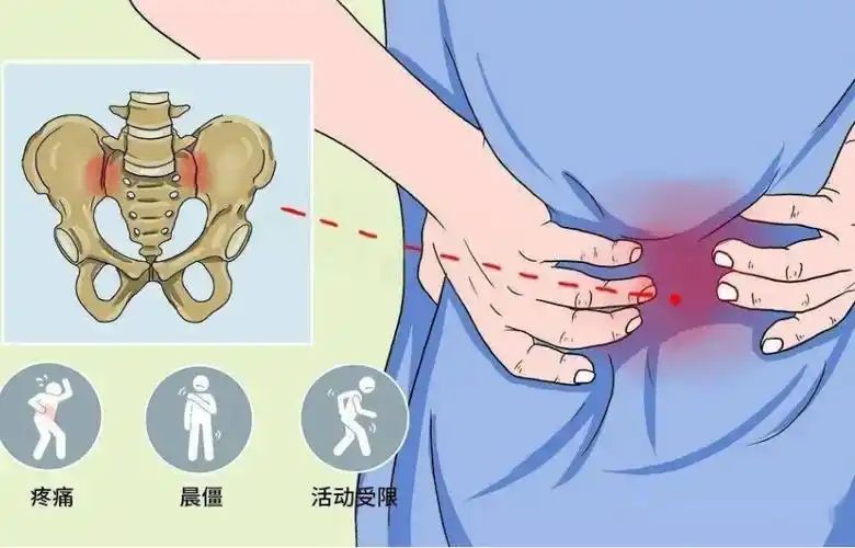骶骨钝痛记得这个小妙招_部位_治疗_坐姿