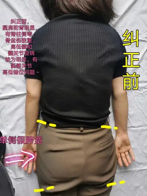 罗氏正骨双桥老太太骨盆修复假胯宽