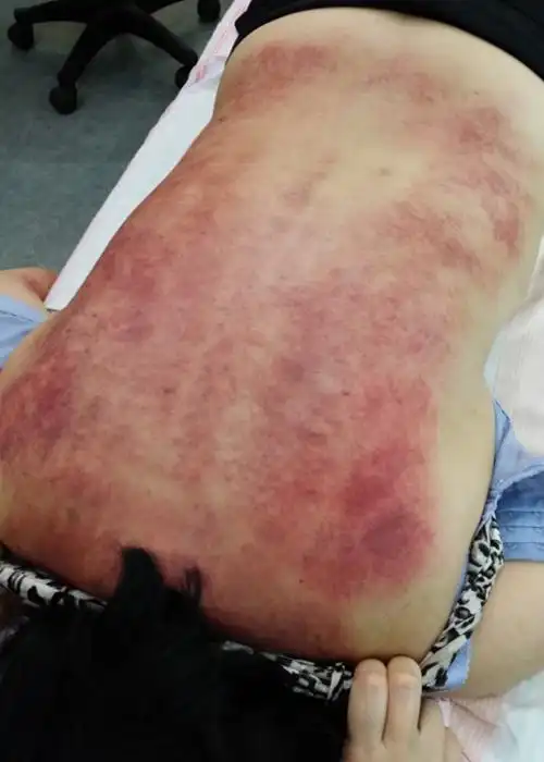 18别有病网第29期刮痧培训纪实