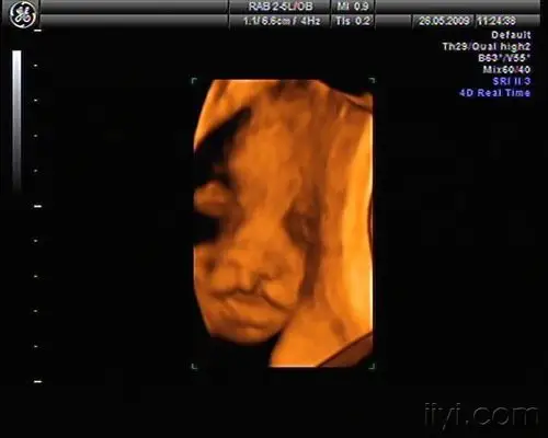 胎儿双侧唇裂四维成像图