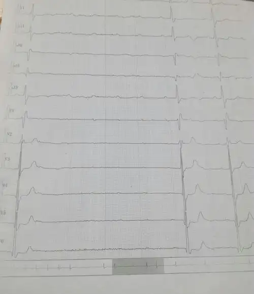 心电图示三度房室传导阻滞,心室停搏
