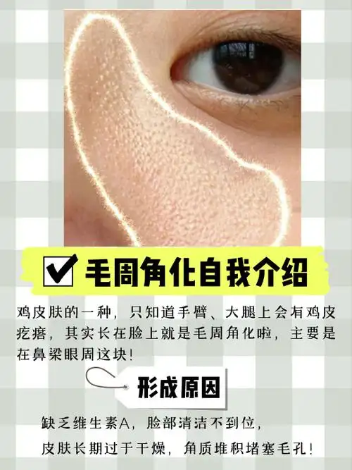 眼部毛周角化