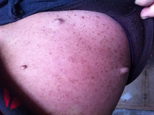 有位亲的身上起了这种疙瘩似的小瘤子,谁能知道这是怎么了,或者这是