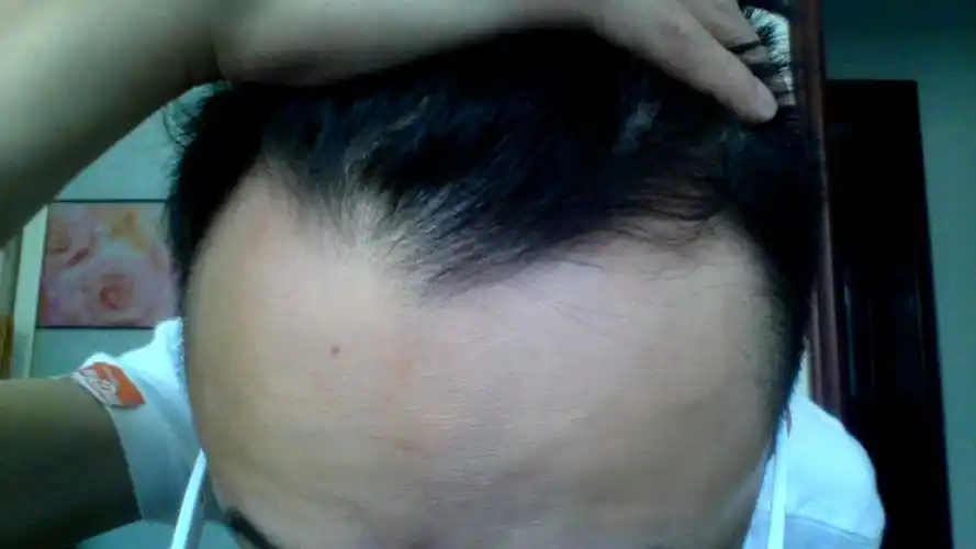 额头上一边一个发旋,而且发量比较少,求发型!