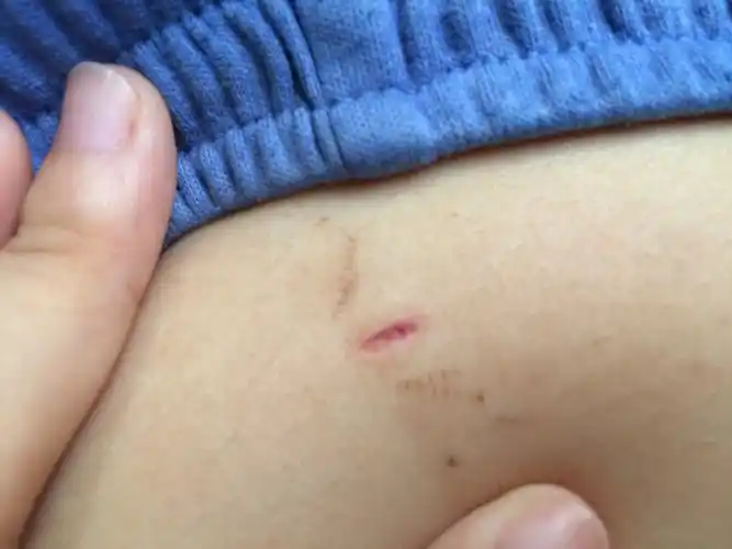 做完阑尾炎手术大半个月了,结痂今天掉了然后长成这样洗澡的时候