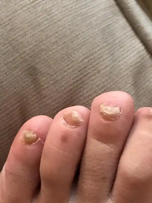 左脚灰指甲前几日修剪大拇指指甲后大脚趾肿胀触碰剧痛另