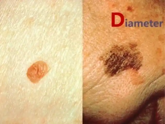 北大肿瘤医院副院长郭军啥样的痣会恶变成黑色素瘤