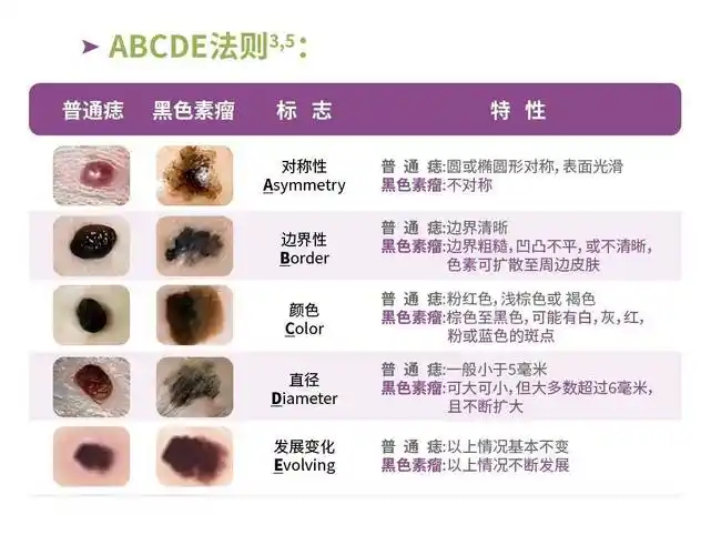 5初步自我判别,如果出现疑似症状,请快快到黑色素瘤规范治疗医院由