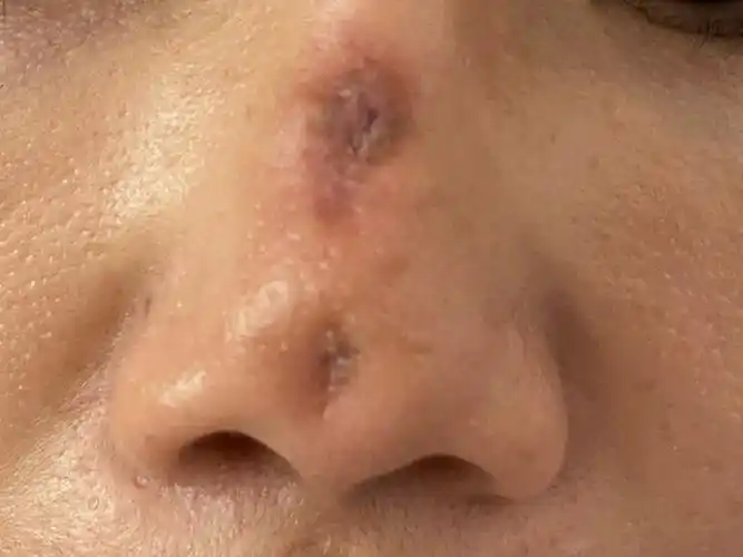 线雕鼻术后鼻头针眼凹陷是什么原因怎么办