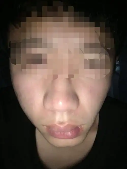 像这样的下颌骨歪斜 导致下巴歪了 有没有什么办法 通过单侧咀嚼可以