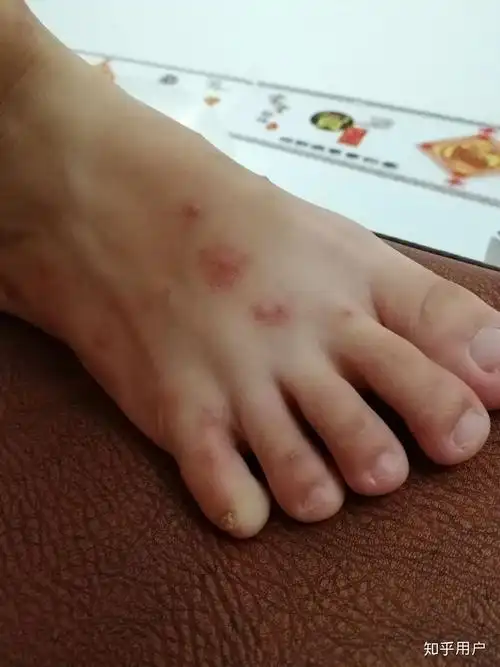 被跳蚤咬的全身都是包是什么样的感受! - 知乎