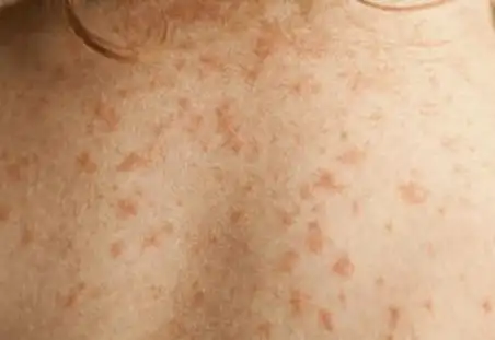 鼻塞,皮疹,喘息以及许多其他症状都是可能出现的过敏反应症状.