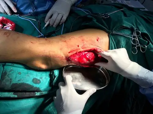 游离阔筋膜移植修复陈旧性跟腱断裂手术