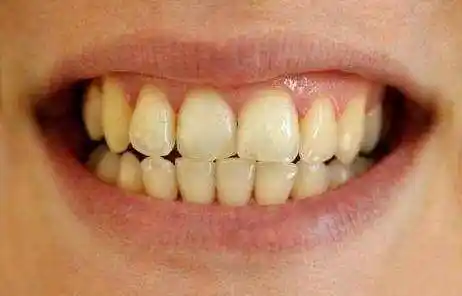 大黄牙怎么办? 教你一个土办法祛除, 不用去洗牙