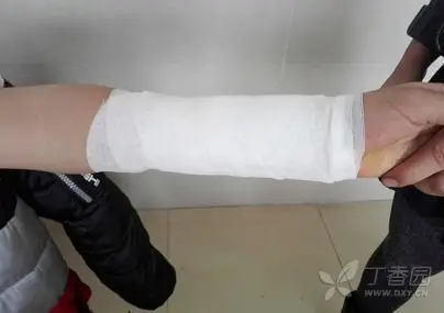 复位完成后外敷蜂蜜绷带及膏药,绷带包扎.