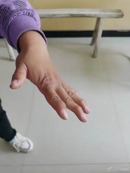 先天性手指畸形