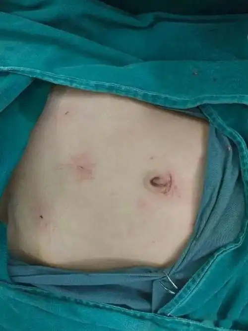 小儿疝气打个"钥匙孔"就能轻松治好……_手术