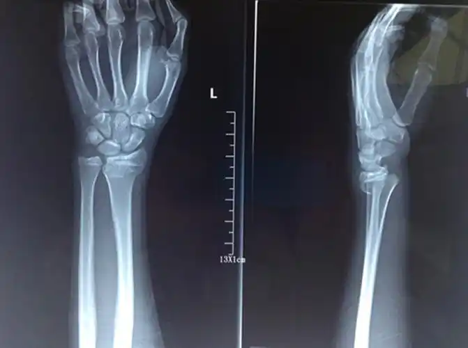 colles骨折