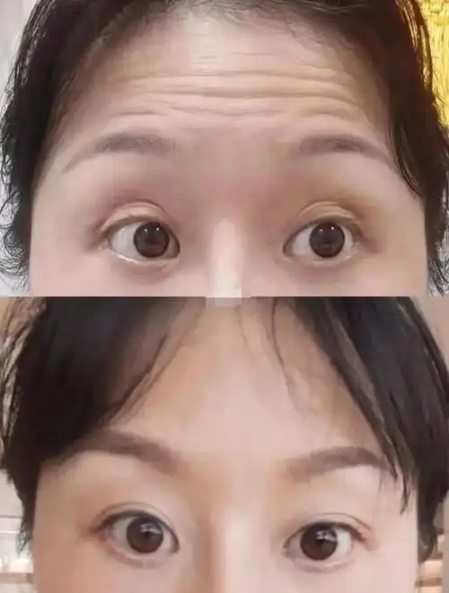 探讨什么是抬头纹,它产生的原因是什么,以及如何预防和治疗