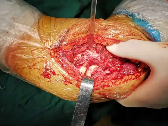 hahn—steinthal骨折【郑州市骨科医院 微创骨科 杨通宝 燕冰】