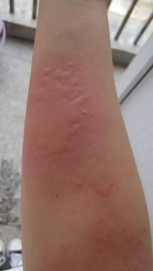 昨天喝了双皮奶,今天就这样过敏了,也不知道是啥过敏,也不知道是不是