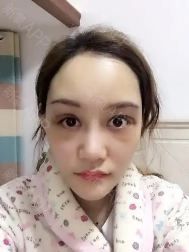 今天是做完眉弓的第八天了.我是联合眼睛泪腺脱垂修复手术一起做的.