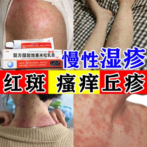 慢性湿疹皮炎湿疹药 皮肤瘙痒大腿内侧瘙痒红疹皮肤红肿瘙痒红斑 皮肤
