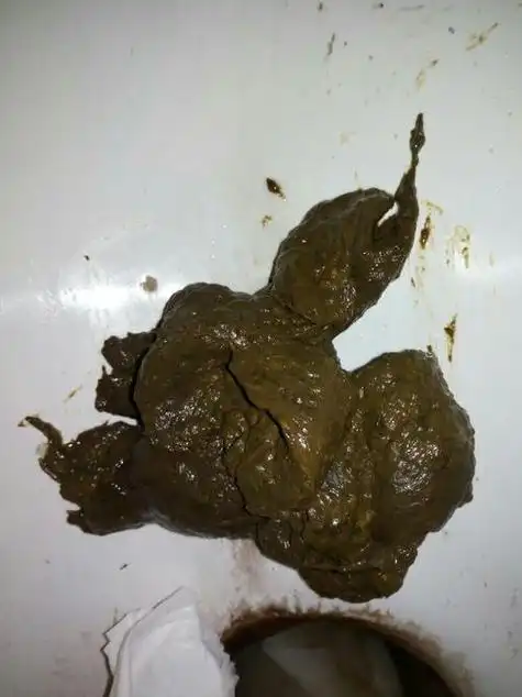 大便颜色深褐色的图片