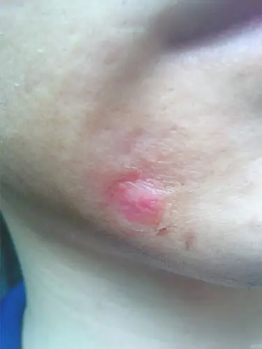 求助:点痣结疤,伤口感染,久治不愈.(附图)