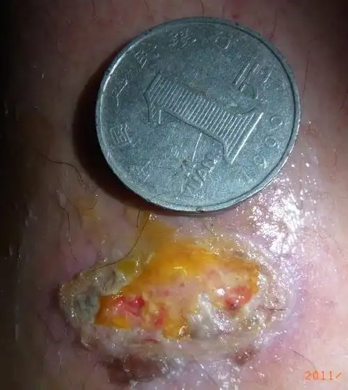 烫伤后打了5天消炎针,医生要我回去涂百多邦,现在伤口流黄水,是怎么