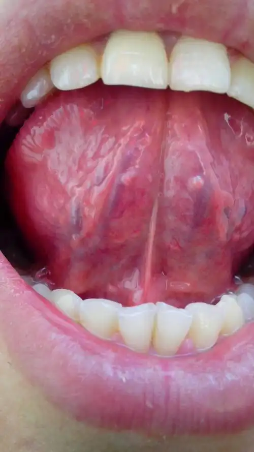 舌头下面的经是不是这个颜色,有人说颜色紫黑是病