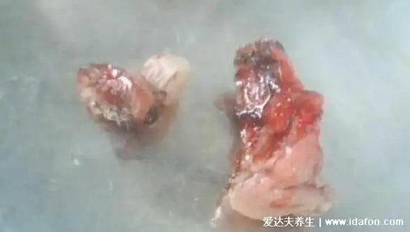 痔疮长什么样子的图片,真实的轻微痔疮图片大全