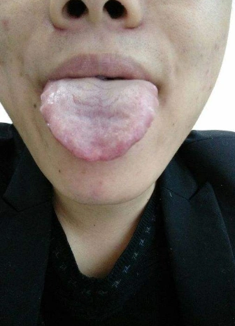 胃炎的症状舌头图片 (34)