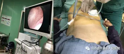 科室配备有硬式膀胱镜尿液动力学检查系统,能够准确快速确定膀胱肿瘤