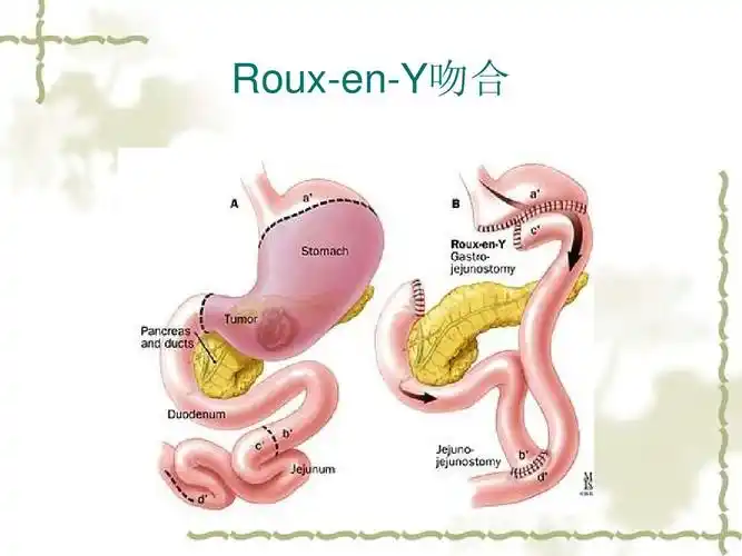 roux-en-y吻合