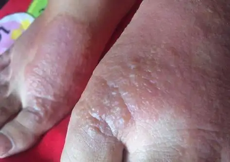 水泡型脚气