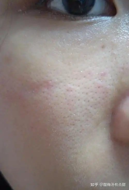 毛孔长摸起来刺刺的拔出来后一条白白硬硬的是什么东西呀