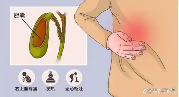 胆囊炎患者可以吃鸡蛋吗医生真正应该忌口的是这2类食物