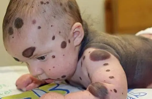 80%皮肤是痣恐转癌 br />4岁娃隆胸保命