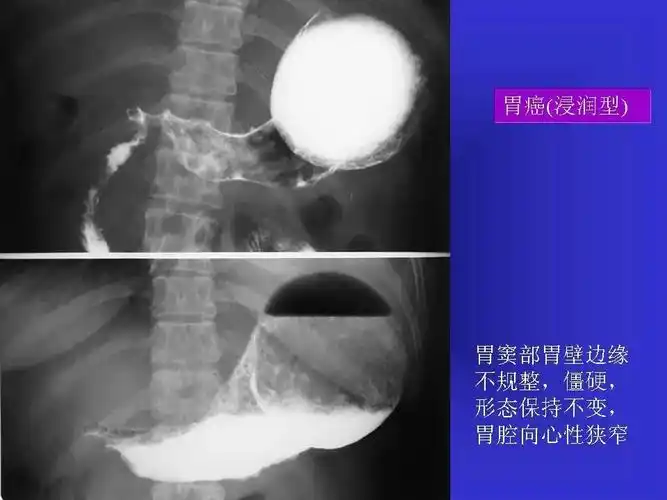 胃溃疡胃癌的影像学表现影像天地