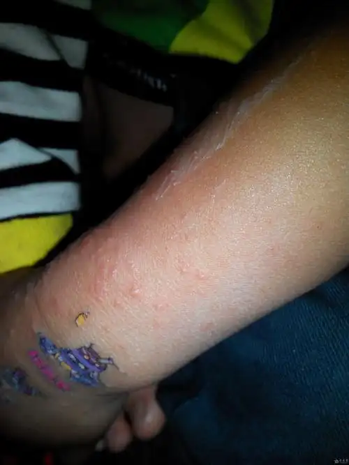 两岁两个月小儿咳嗽一星期而后手臂出现粟粒样疹