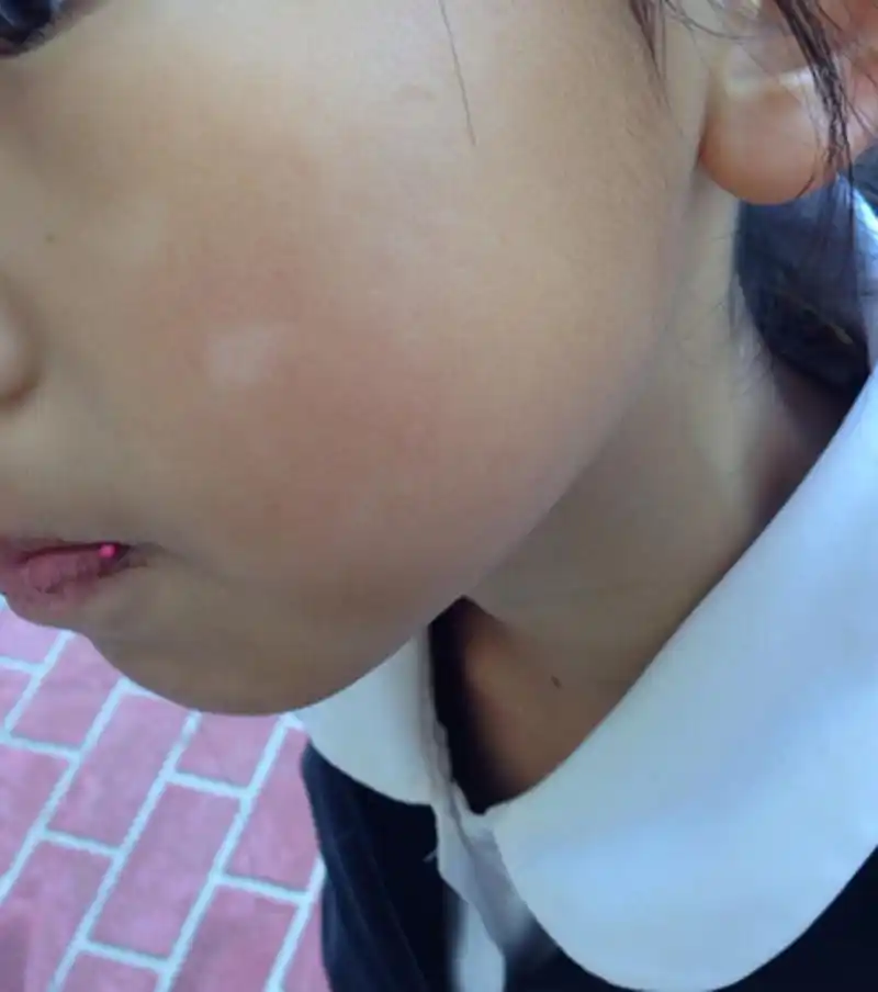 脸上出现了一小块白色斑块,怎么辨别是癣还是白癜风?