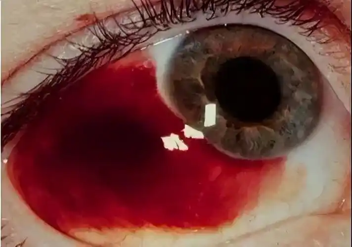 眼球发红充血怎么回事 一只眼睛红了怎么办-伙伴百科网-让你的生活