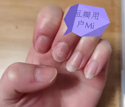 长了很久的指甲总有分层,怎么办呀