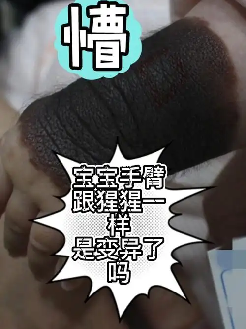 宝宝黑色手臂长毛如同猩猩一样是怎么了_胎记_黑毛痣_母婴_育儿经验